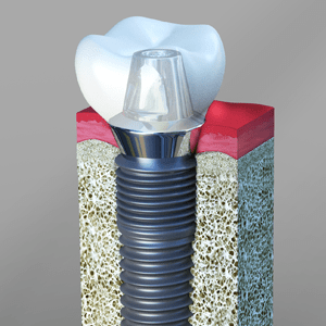 Dental Implants as an example of oral surgery in Cary NC